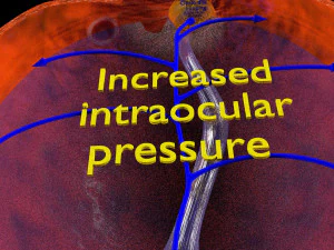Diabetic eye diseases model 3D Model