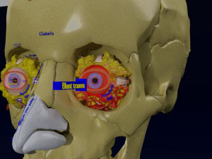 Eye blow out injury 3d 3D Модель