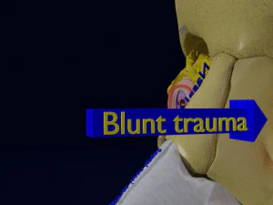 Eye blow out injury 3d 3D Model