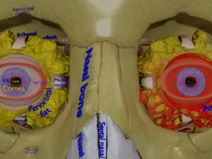 Eye blow out injury 3d 3D Модель