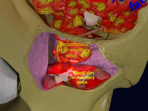 Eye blow out injury 3d 3D Model