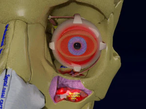 Eye blow out injury 3d 3D Model