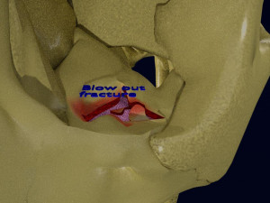 Eye blow out injury 3d 3D Модель