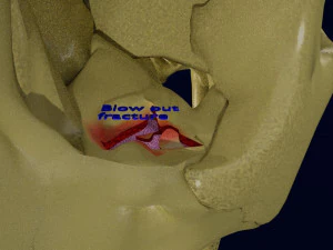 Eye blow out injury 3d 3D Model