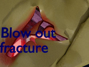 Eye blow out injury 3d 3D Model