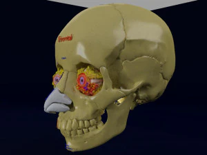 Eye blow out injury 3d 3D Model