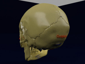 Eye blow out injury 3d 3D Модель