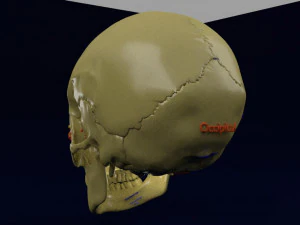 Eye blow out injury 3d 3D Model