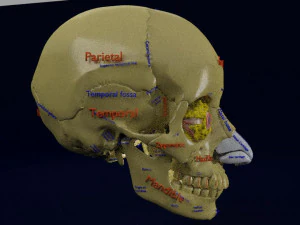 Eye blow out injury 3d 3D Model