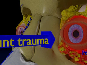 Eye blow out injury 3d 3D Model