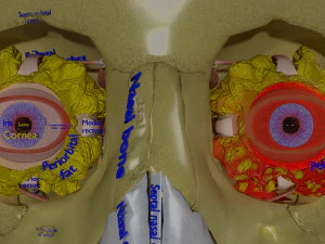 Eye blow out injury 3d 3D Model