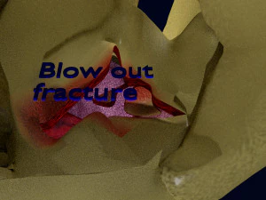 Eye blow out injury 3d 3D Model