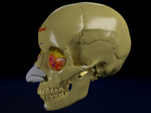 Eye blow out injury 3d 3D Модель