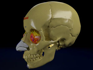 Eye blow out injury 3d 3D Model