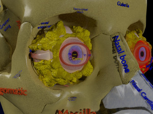 Eye blow out injury 3d 3D Модель