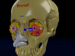 Eye blow out injury 3d 3D Model