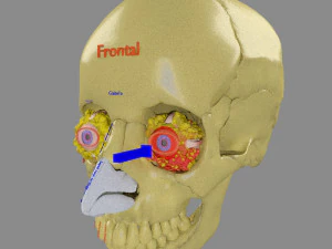 Eye blow out injury 3d 3D Model