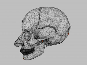 Eye blow out injury 3d 3D Модель