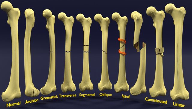 Fracture types labelled Model 3D .c4d .max .obj .3ds .fbx .stl .blend 