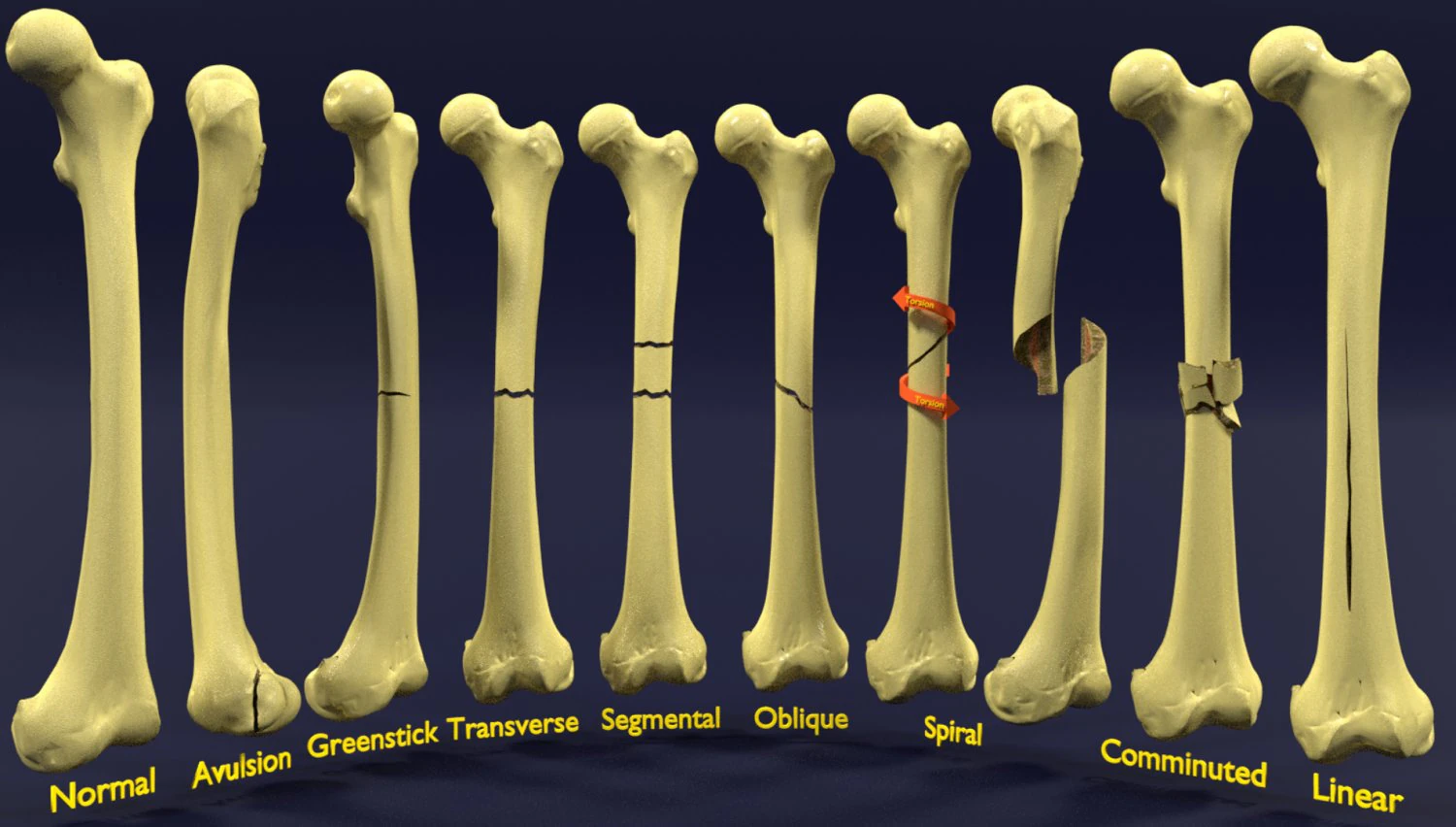 Fracture types labelled 3D Model .c4d .max .obj .3ds .fbx .stl .blend 