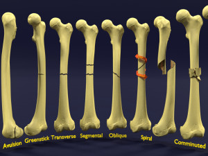 Fracture types labelled 3D Model