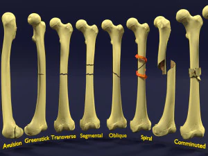 분류된 골절 유형 3D 모델