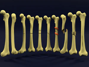 Fracture types labelled 3D Model