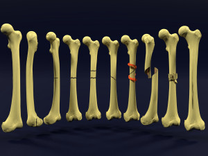 Fracture types labelled Model 3D