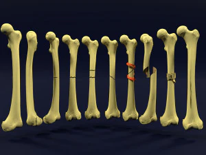 Fracture types labelled 3D Model