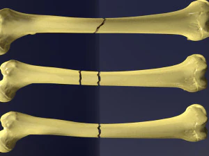 Fracture types labelled 3D Model