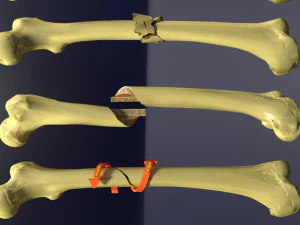Fracture types labelled 3D Model