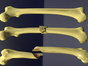 Fracture types labelled 3D Model