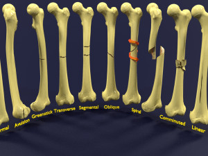 Fracture types labelled Model 3D
