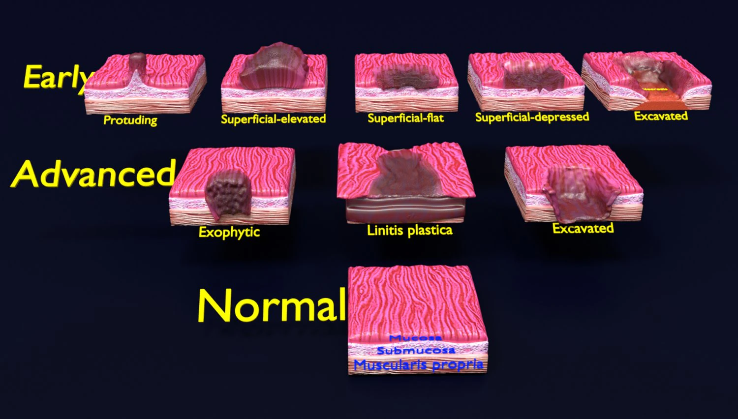 Gastric stomach cancer stages labelled 3D Model .c4d .max .obj .3ds .fbx .stl .blend