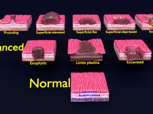 Gastric stomach cancer stages labelled 3D 모델