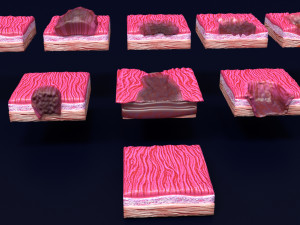 Gastric stomach cancer stages labelled Model 3D