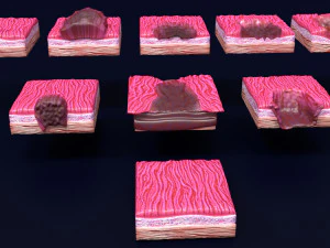 Gastric stomach cancer stages labelled 3D Model