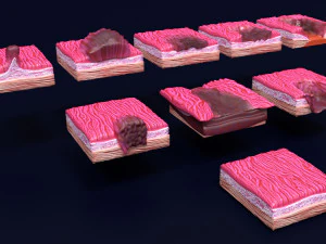 Gastric stomach cancer stages labelled 3D Model
