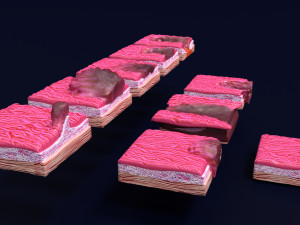 Gastric stomach cancer stages labelled Model 3D