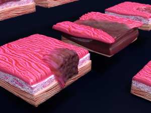 Gastric stomach cancer stages labelled Model 3D