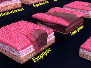 Gastric stomach cancer stages labelled Model 3D