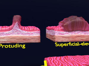 Gastric stomach cancer stages labelled Model 3D