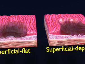 Gastric stomach cancer stages labelled Model 3D