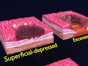 Gastric stomach cancer stages labelled Model 3D