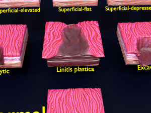 Gastric stomach cancer stages labelled Model 3D