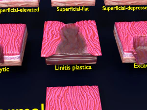 Gastric stomach cancer stages labelled 3D Model