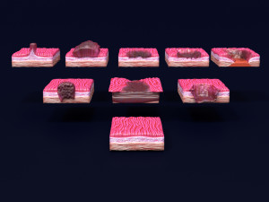 Gastric stomach cancer stages labelled Model 3D