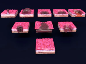 Gastric stomach cancer stages labelled 3D Model