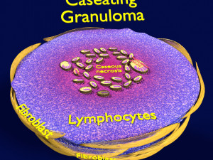 3D Caseating granuolma tuberculosis labelled model 3Dモデル