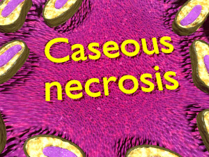 3D Caseating granuolma tuberculosis labelled model Modelo 3D
